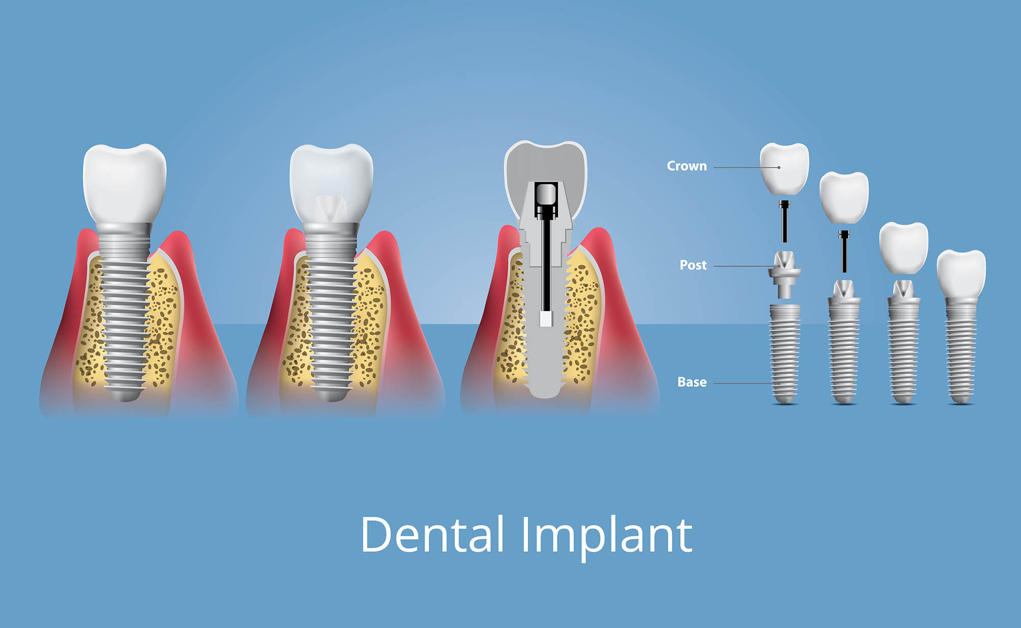 dis-implanti3